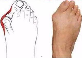 明星脚外翻怎么矫正,轻松恢复美丽步态